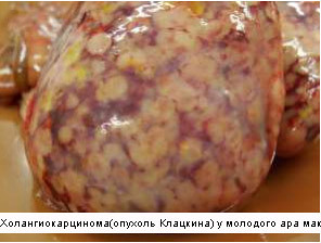 Файл:Опухоль клацкина.JPG